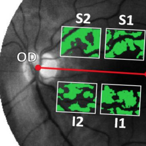 Hyperspectral retinal imaging for non-invasive detection of amyloid-β in patients with Alzheimer disease (HERALD)